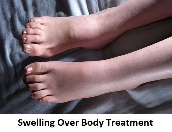 SWELLING OVER BODY TREATMENT